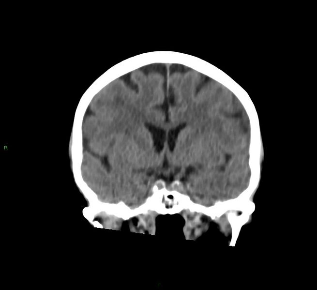 File:Cerebral amyloid angiopathy-associated lobar intracerebral hemorrhage (Radiopaedia 58757-65978 Coronal non-contrast 41).jpg