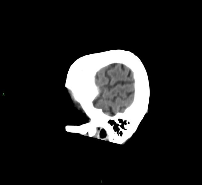 File:Cerebral amyloid angiopathy-associated lobar intracerebral hemorrhage (Radiopaedia 58758-65980 C 48).jpg