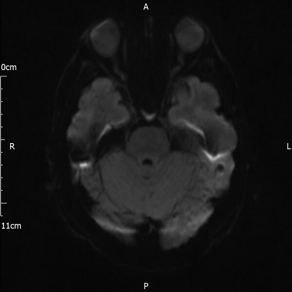 File:Cerebral amyloid angiopathy related inflammation (Radiopaedia 72772-83415 Axial DWI 31).jpg