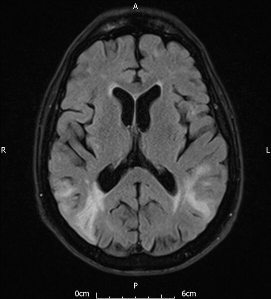 File:Cerebral amyloid angiopathy related inflammation (Radiopaedia 72772-83415 Axial FLAIR 13).jpg