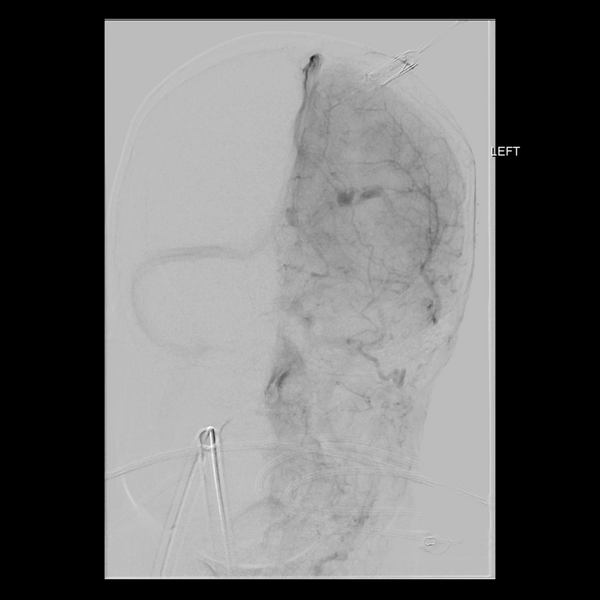 File:Cerebral arteriovenous malformation with lobar hemorrhage (Radiopaedia 44725-48513 LT CCA IC 17).png