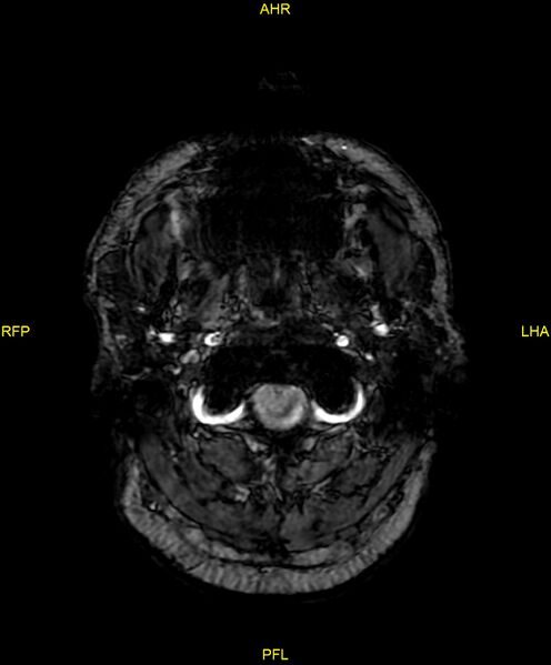 File:Cerebral autosomal dominant arteriopathy with subcortical infarcts and leukoencephalopathy (CADASIL) (Radiopaedia 86108-102054 Axial SWI 3).jpg