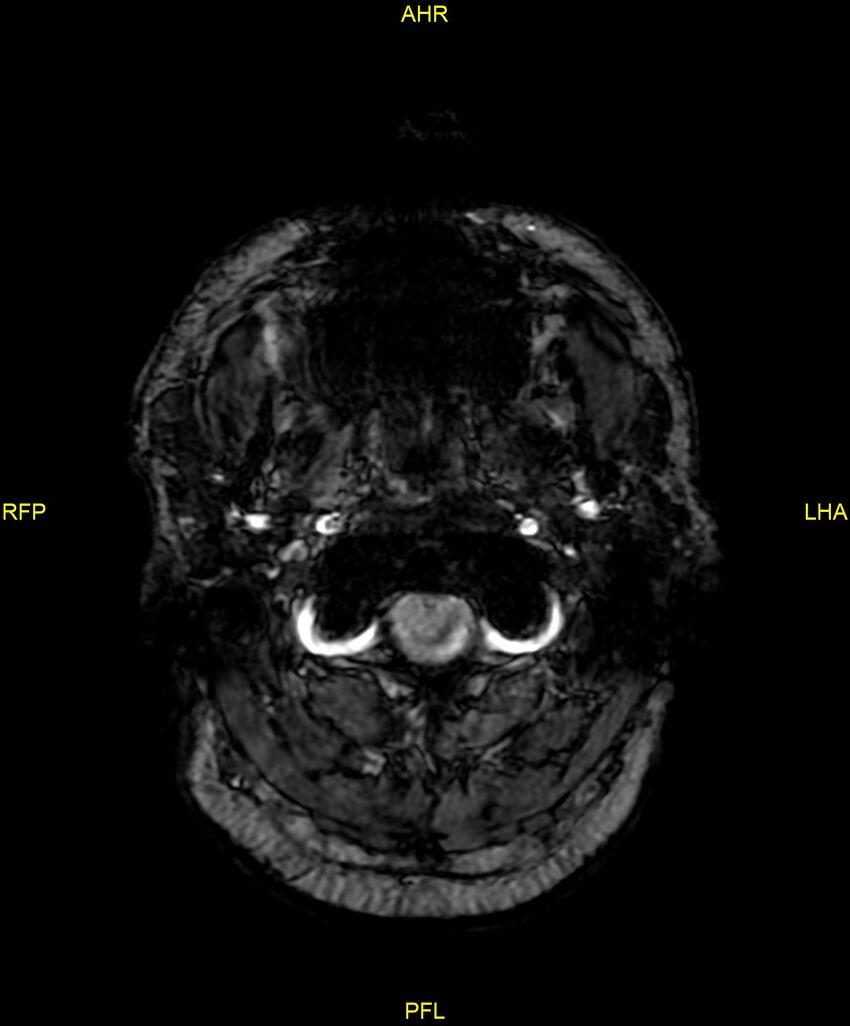 Cerebral autosomal dominant arteriopathy with subcortical infarcts and leukoencephalopathy (CADASIL) (Radiopaedia 86108-102054 Axial SWI 3).jpg