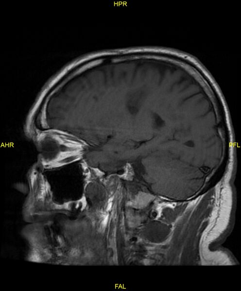 File:Cerebral autosomal dominant arteriopathy with subcortical infarcts and leukoencephalopathy (CADASIL) (Radiopaedia 86108-102054 Sagittal T1 10).jpg