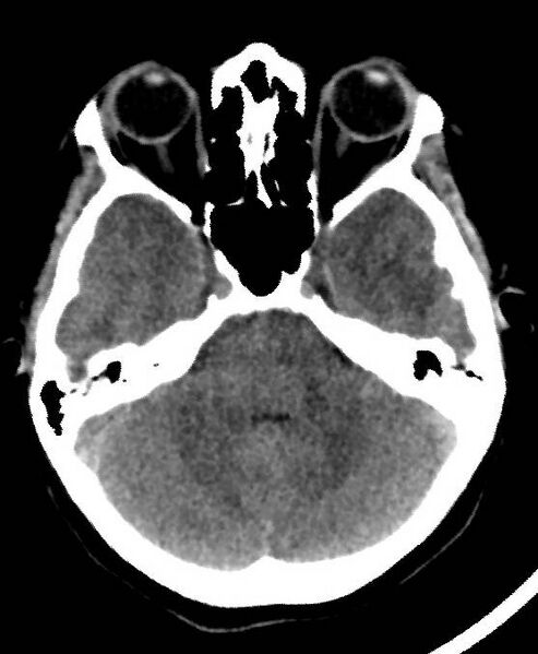 File:Cerebral edema due to severe hyponatremia (Radiopaedia 89826-106937 Axial non-contrast 25).jpg
