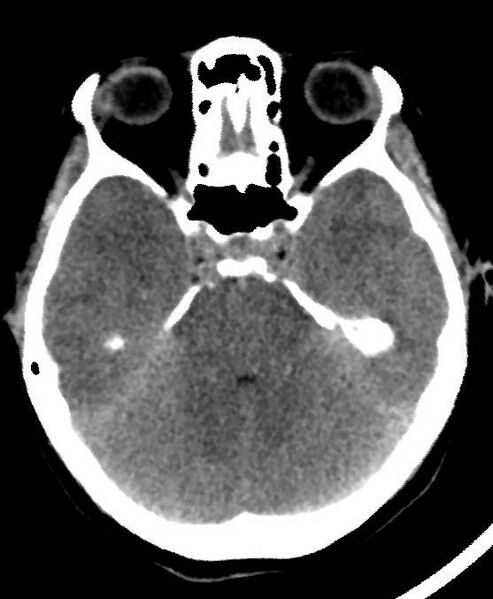 File:Cerebral edema due to severe hyponatremia (Radiopaedia 89826-106937 Axial non-contrast 28).jpg