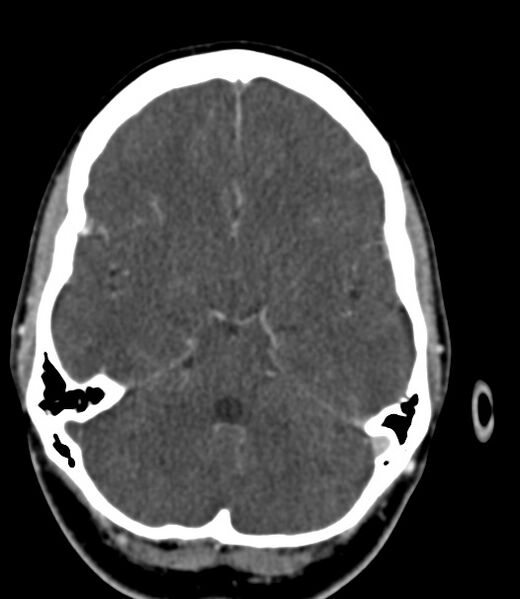 File:Cerebral venous sinus thrombosis (Radiopaedia 59224-66646 Axial C+ delayed 35).jpg