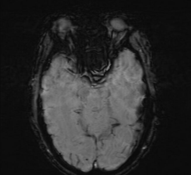 File:Cerebral venous thrombosis (Radiopaedia 71207-81504 Axial SWI 18).jpg