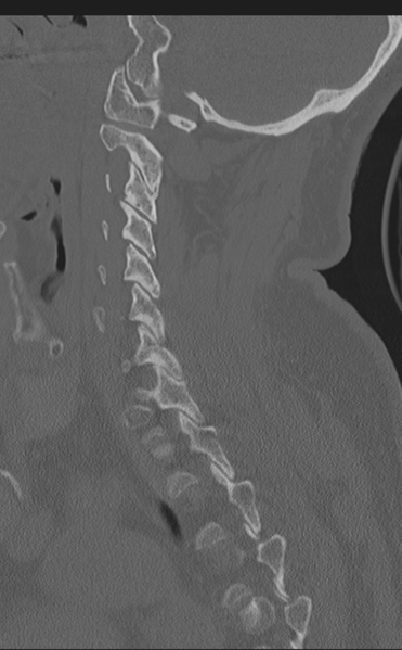 File:Cervical canal stenosis - OPLL and osteophytes (Radiopaedia 47329-51910 Sagittal bone window 26).png