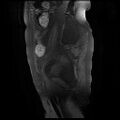 Cervical carcinoma (Radiopaedia 78847-91705 Sagittal T1 fat sat 15).jpg
