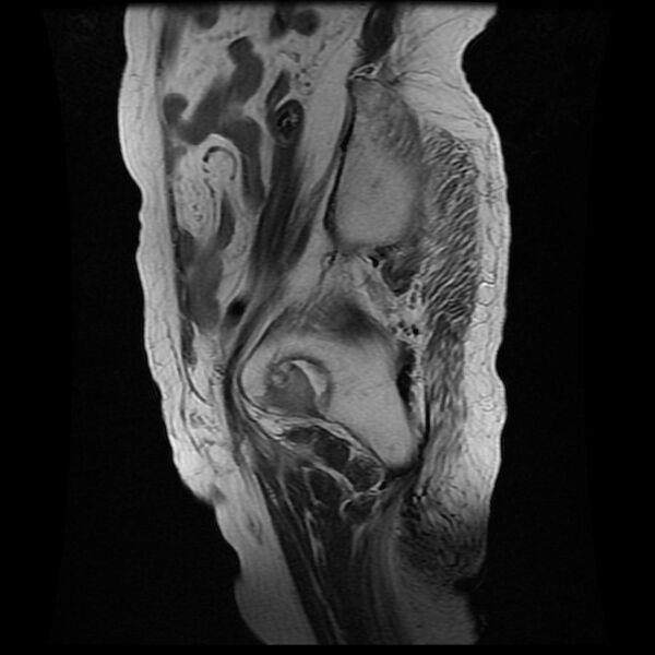 File:Cervical carcinoma (Radiopaedia 78847-91705 Sagittal T2 2).jpg