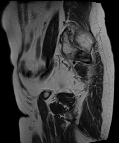 File:Cervical carcinoma (Radiopaedia 88312-104943 Sagittal T2 8).jpg