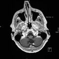 Cervical dural CSF leak on MRI and CT treated by blood patch (Radiopaedia 49748-54995 Axial T1 C+ 18).jpg