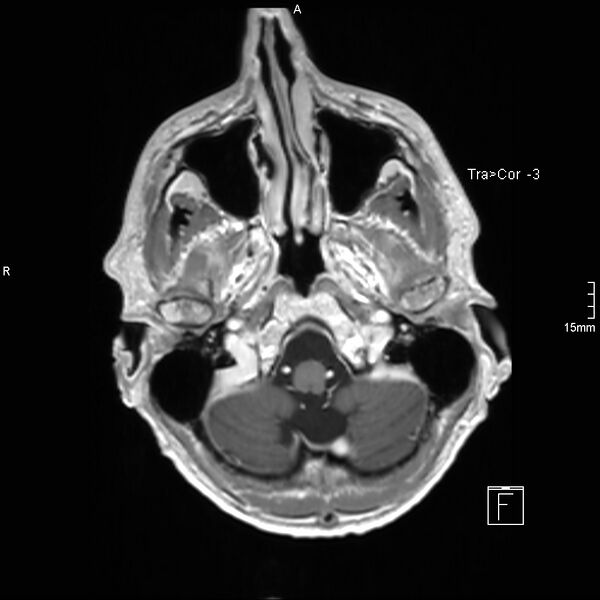 File:Cervical dural CSF leak on MRI and CT treated by blood patch (Radiopaedia 49748-54995 Axial T1 C+ 18).jpg