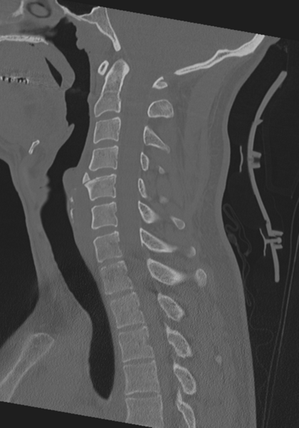 File:Cervical intercalary bone (Radiopaedia 35211-36748 Sagittal bone window 41).png