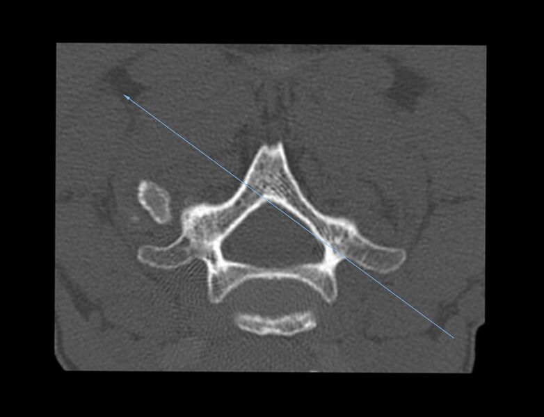 File:Cervical interlaminar epidural steroid injection (fluoroscopic guided) (Radiopaedia 77352-89457 Axial bone window 1).jpg