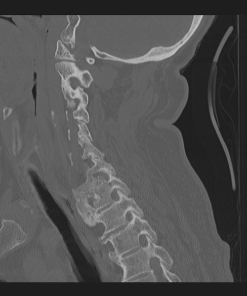 File:Cervical spine fracture in the setting of ankylosis (Radiopaedia 37038-38715 Sagittal bone window 49).png