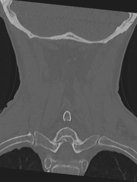 File:Cervical spondylolysis (Radiopaedia 49616-54811 Coronal bone window 44).png