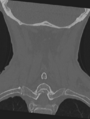 Cervical spondylolysis (Radiopaedia 49616-54811 Coronal bone window 44).png