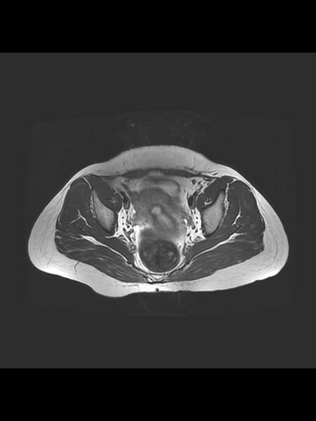 File:Cesarean section scar endometrioma (Radiopaedia 56569-63297 Axial T2 15).jpg