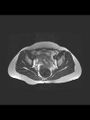 Cesarean section scar endometrioma (Radiopaedia 56569-63297 Axial T2 15).jpg