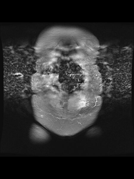 File:Cesarean section scar endometrioma (Radiopaedia 56569-63297 Coronal STIR 5).jpg