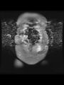 Cesarean section scar endometrioma (Radiopaedia 56569-63297 Coronal STIR 5).jpg