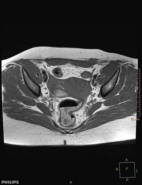 File:Cesarian scar endometriosis (Radiopaedia 68495-78066 Axial T1 12).jpg