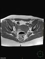 Cesarian scar endometriosis (Radiopaedia 68495-78066 Axial T1 12).jpg
