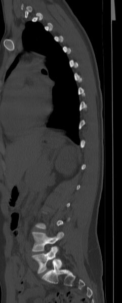 File:Chance fracture (Radiopaedia 45345-49372 Sagittal bone window 20).jpg