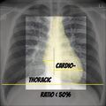 Chest x-ray - circulation (Radiopaedia 32664-33633 C 1).jpg