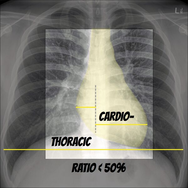 File:Chest x-ray - circulation (Radiopaedia 32664-33633 C 1).jpg