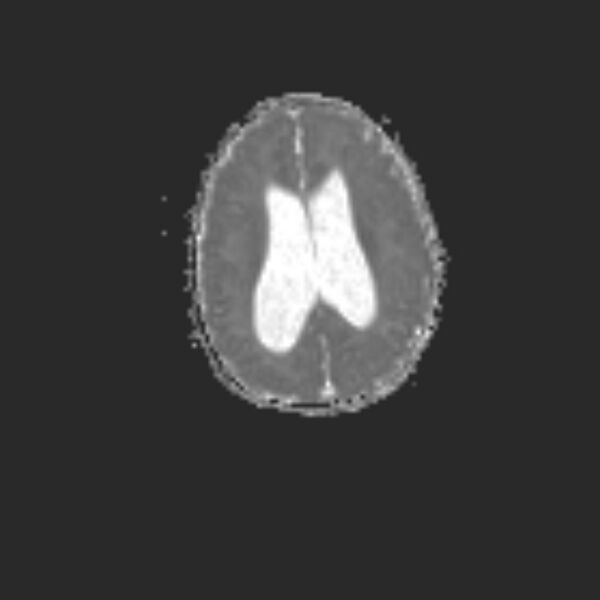 File:Chiari III malformation with occipital encephalocele (Radiopaedia 79446-92559 Axial ADC 16).jpg