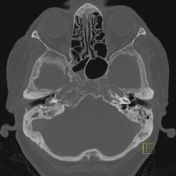 File:Cholesteatomatous chronic otitis (Radiopaedia 14993-14911 Axial bone window 13).JPEG