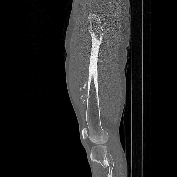 File:Chondrosarcoma arising from exostosis (Radiopaedia 59996-67507 Sagittal bone window 1).jpg