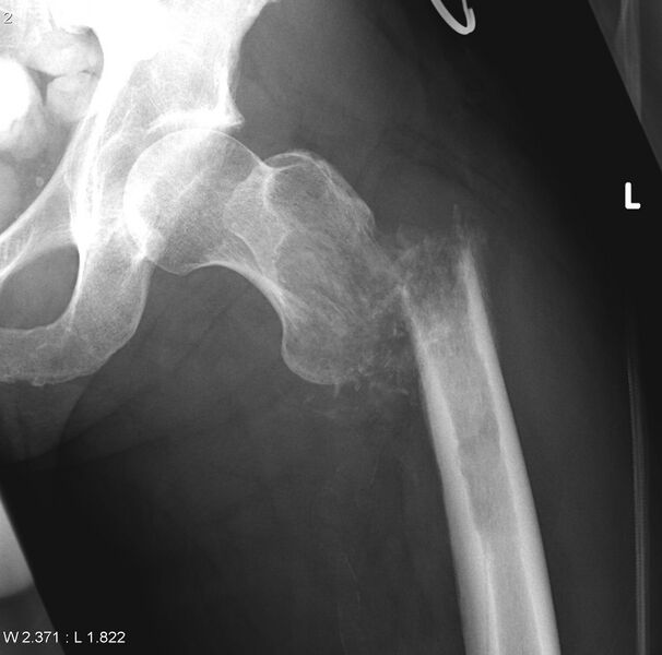 File:Chondrosarcoma with pathological fracture - femur (Radiopaedia 6174-7628 Frontal 1).jpg