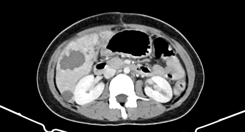File:Choriocarcinoma liver metastases (Radiopaedia 74768-85766 A 97).jpg