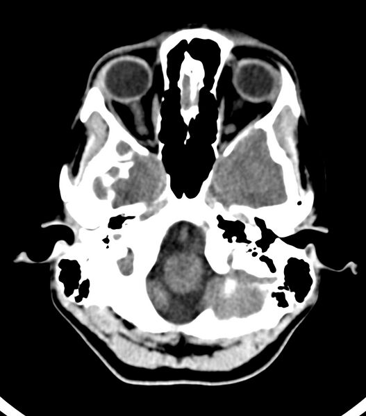 File:Choroid plexus carcinoma (Radiopaedia 91013-108552 Axial non-contrast 13).jpg