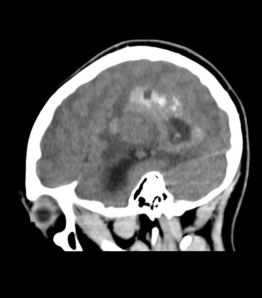 File:Choroid plexus carcinoma (Radiopaedia 91013-108552 B 56).jpg