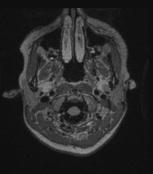 File:Choroid plexus carcinoma (Radiopaedia 91013-108553 Axial FLAIR C+ 69).jpg