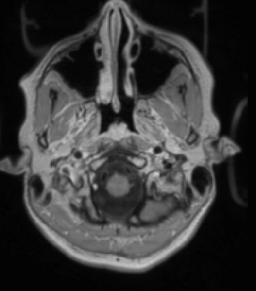 File:Choroid plexus carcinoma (Radiopaedia 91013-108553 Axial T1 C+ 78).jpg