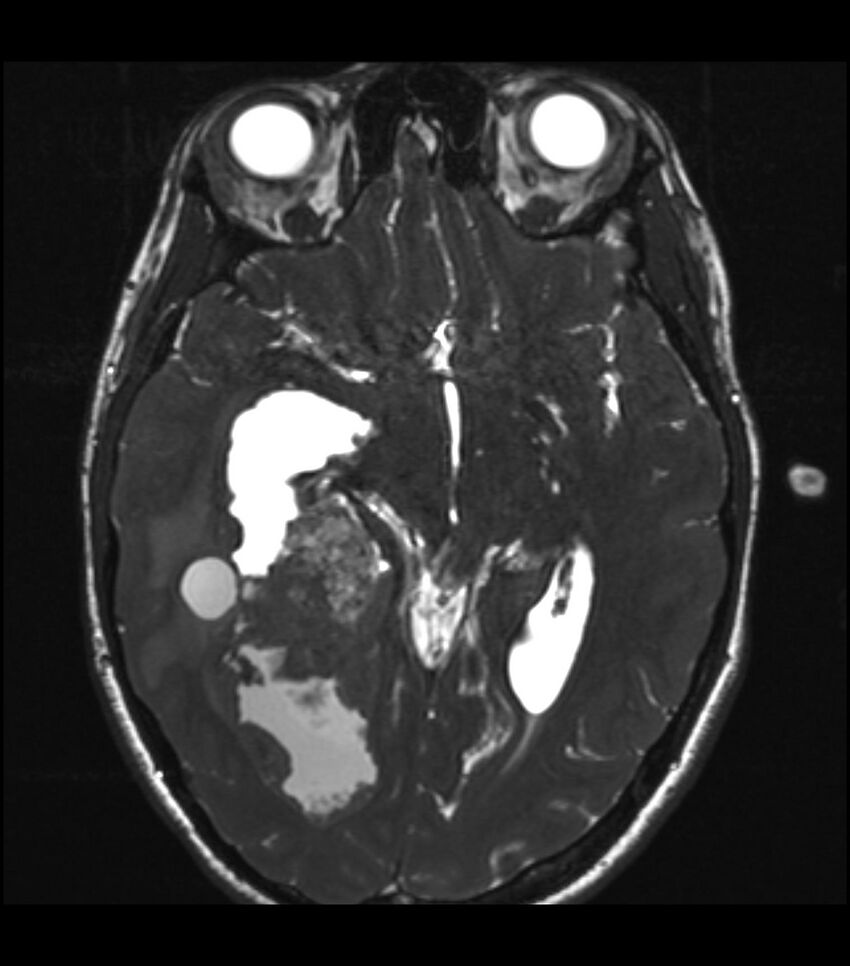 Choroid plexus carcinoma (Radiopaedia 91013-108553 Axial T2 CISS 27).jpg