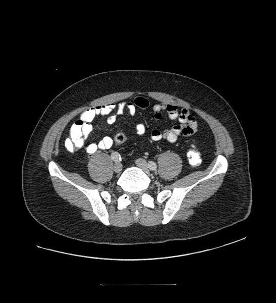 File:Chromophobe renal cell carcinoma (Radiopaedia 84337-99644 C 94).jpg