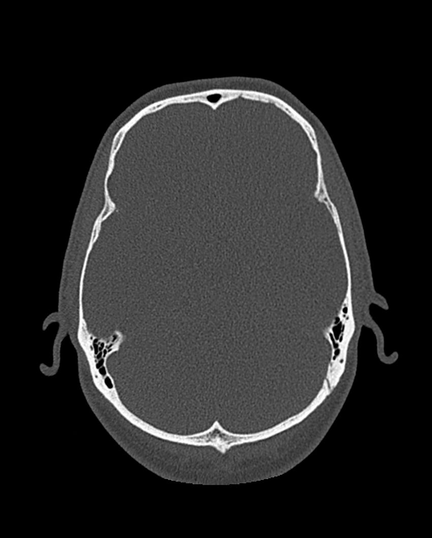 Chronic maxillary sinusitis caused by a foreign body (Radiopaedia 58521-65676 Axial bone window 306).jpg