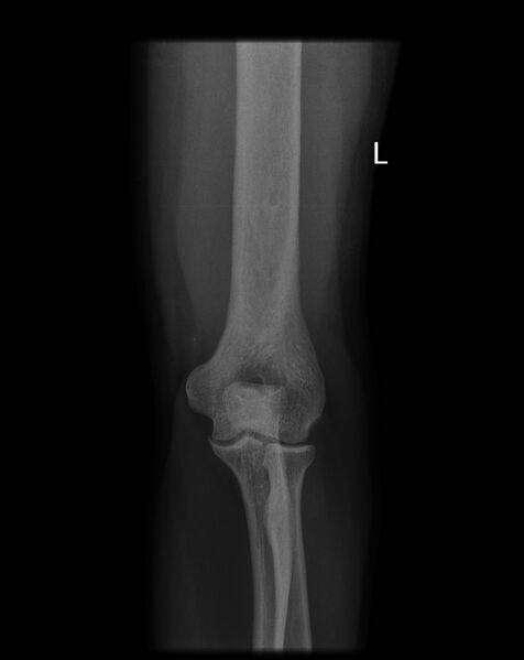 File:Chronic osteomyelitis (Radiopaedia 67597-76998 AP & Lat Old X-ray 1).jpg