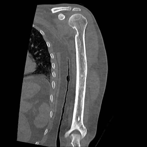 File:Chronic osteomyelitis (Radiopaedia 67597-76998 Coronal bone window 9).jpg