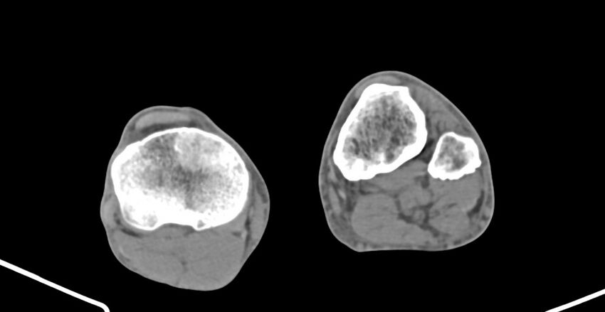 Chronic osteomyelitis (with sequestrum) (Radiopaedia 74813-85822 D 201).jpg