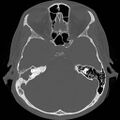 Chronic otomastoiditis (Radiopaedia 27138-27309 Axial bone window 44).jpg