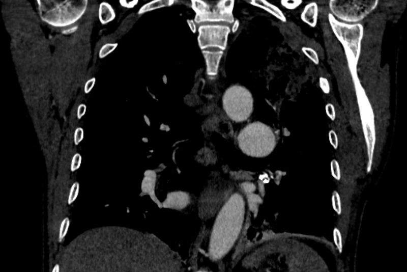 File:Chronic pulmonary embolism with bubbly consolidation (Radiopaedia 91248-108850 B 90).jpg