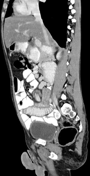 File:Chronic small bowel volvulus (Radiopaedia 75224-86322 C 87).jpg